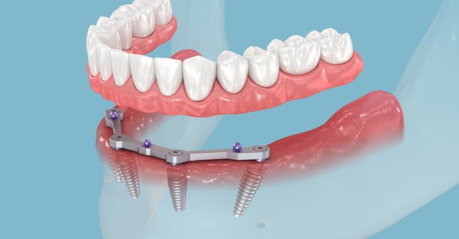 All-On-4-implant-gorsel