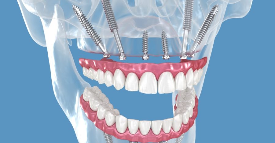 zigomatik-implant-gorsel
